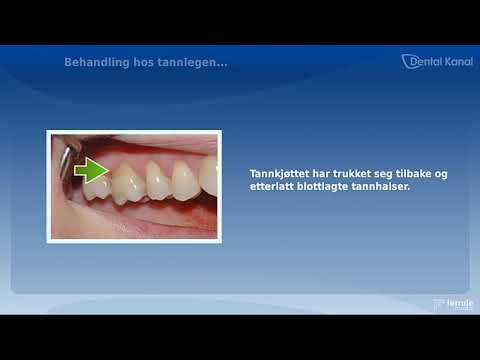 , title : 'Børsteskader | Skader etter tannpuss - Tanntunet Tannhelsesenter'