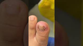 Ep_8180 Ingrown toenail removal 👣 Come see P'Eum..don't believe Google Maps 😄 (clip from Thailand)