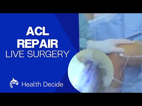 Patellar Dislocation 3D Animation Live Surgery