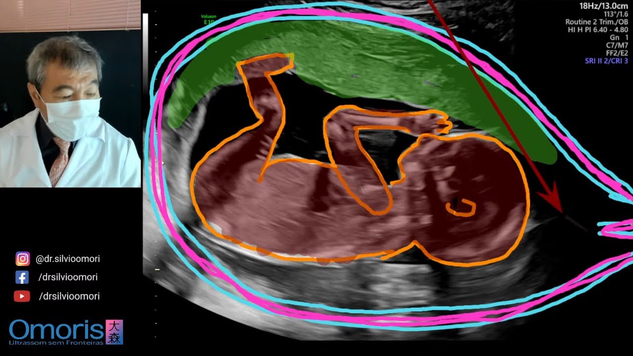 Menino ou menina Gravidez 17 semanas.