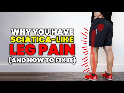 It's Referral Pain not Sciatica! How the gluteus minimus can mimic sciatica and how to fix it