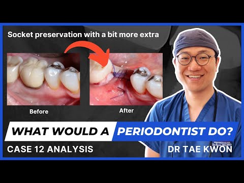 What Would A Periodontist Do? With Dr Tae Kwon - Case 12