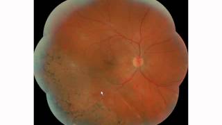 Advanced Retinal Camera