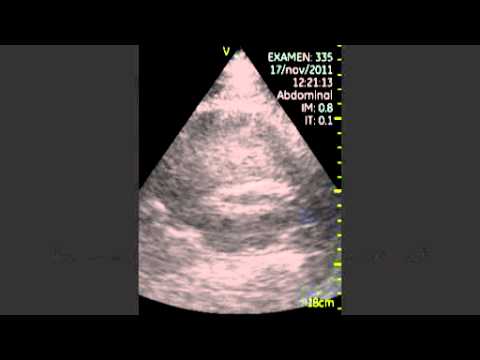 Ruptured Abdominal Aortic Aneurysm - Postoperative Ultrasound