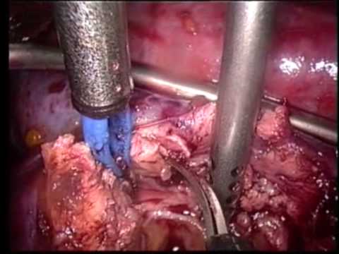 Renal Parenchyma Clamping During Partial Nephrectomy - Laparoscopy 