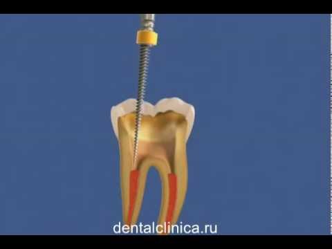 Лечение пульпита зуба Реконструктивная стоматология European Clinic of Aesthetic Dentistry