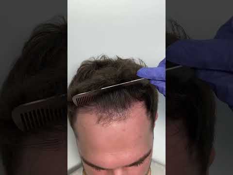 Evaluating Frontal Hairline Restoration and FUE Hair Transplant in Istanbul, Turkey