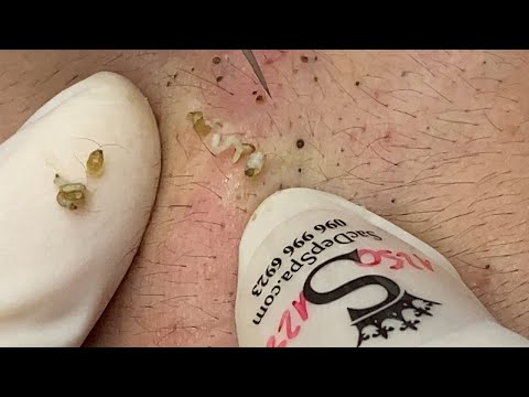 Blackhead Removal – Satisfying Extractions