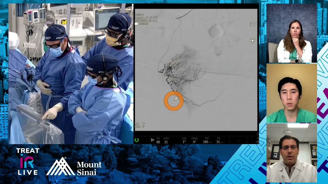 Prostate Artery Embolization procedure