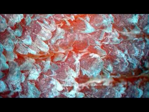 Die Magnesia bei der Schuppenflechte Das eiterige Ekzem der Finger der Hände