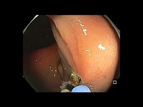 Colonoscopia - pólipo atado de colon ascendente