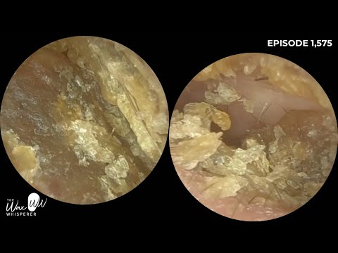 1,575 - Dry & Itchy Dead Skin Removal