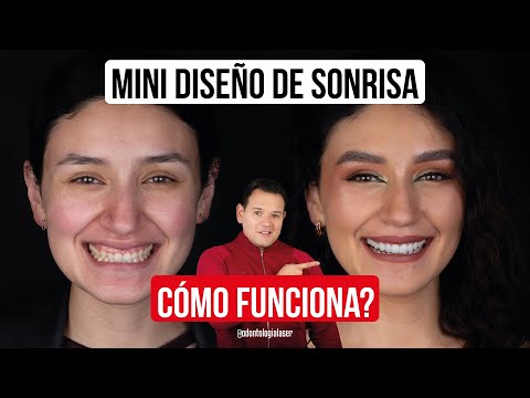 Diseño de sonrisa vs carillas cerámicas