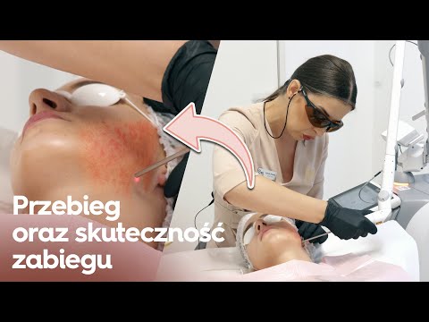 USUWANIE PRZEBARWIEŃ NA SKÓRZE - MELASMA 4D - BEZ SKALPELA