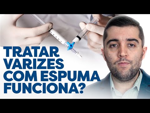 Mitos e verdades ao tratar varizes: cirurgia, espuma, laser, qual é melhor? Varizes podem voltar?
