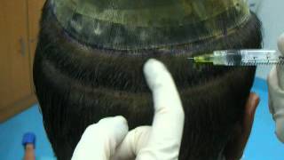 preview picture of video 'Hair Transplant Lahore - Step by Step Procedure'