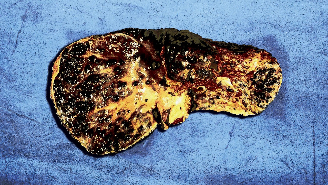 A Family Ate 1 Year Old Frozen Leftovers For Breakfast. This Is What Happened To Their Organs.