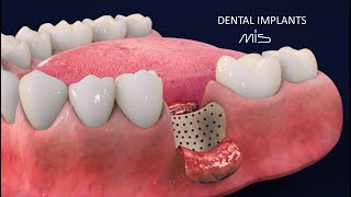 How to Perform Dental Implants by MIS -Tutorial (3D Dental Animation)