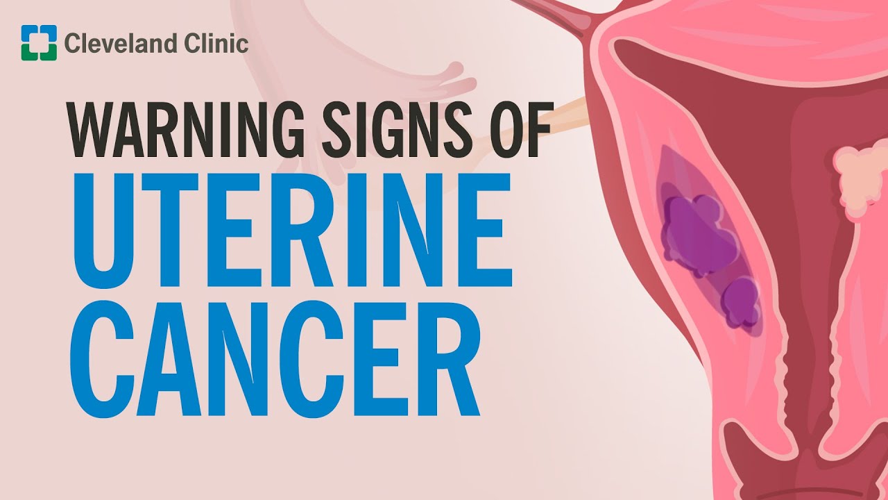 The Most Common Warning Sign of Uterine Cancer