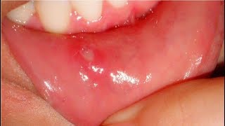 how to get rid of canker sores in minutes