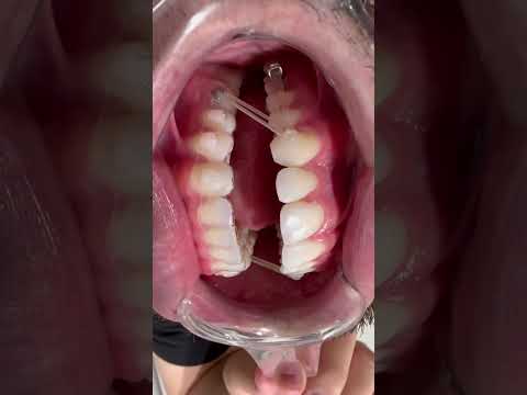 🔥Distalizador estético Carriere🔥