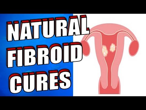 20 Natural Ways to Treat & Shrink Fibroids Easily | Natural Cures for Fibroids