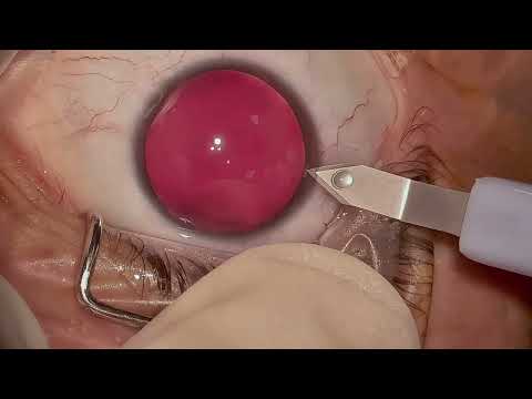 Lente Fáquica para Miopia (ICL)