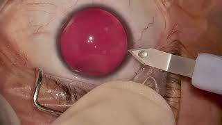 Lente Fáquica para Miopia (ICL)