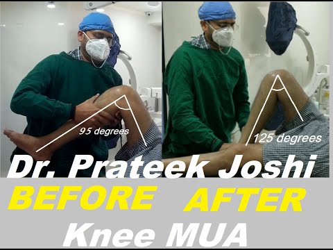KNEE MANIPULATION UNDER ANAESTHESIA (MUA) - DR. PRATEEK JOSHI | KNEE STIFFNESS |