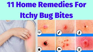 11 Home Remedies For Itchy Bug Bites