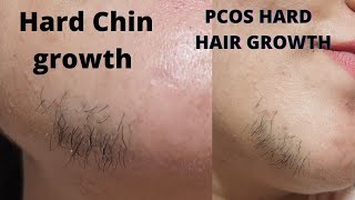 आदमी जैसे बाल अगये है|औरत होने के बाद भी|लोगो को लगता है मैं क्या हु😶Hard chin growth|#dailyvlog