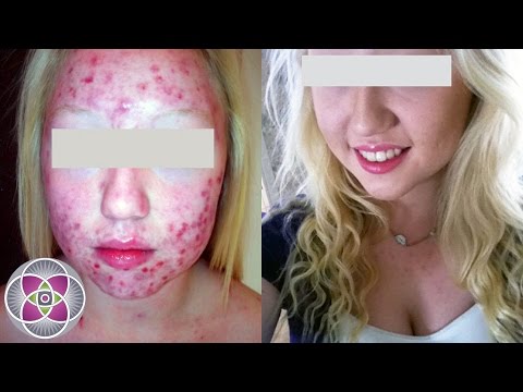 download lagu mp3 mp4 Fotona Laser Acne Treatment, download lagu Fotona Laser Acne Treatment gratis, unduh video klip Fotona Laser Acne Treatment