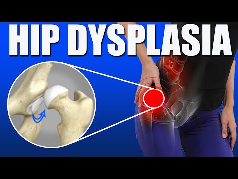Hip Dysplasia l (Pain Relief Exercises l Causes l Diagnosis l Symptoms)