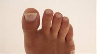 How To Remedy Yellow Toenails