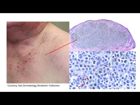DP60 episode 79 red brown papules on chest