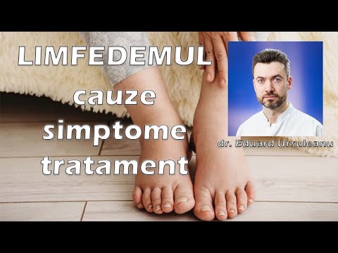 yoga cu vene varicoase de pelvis mic
