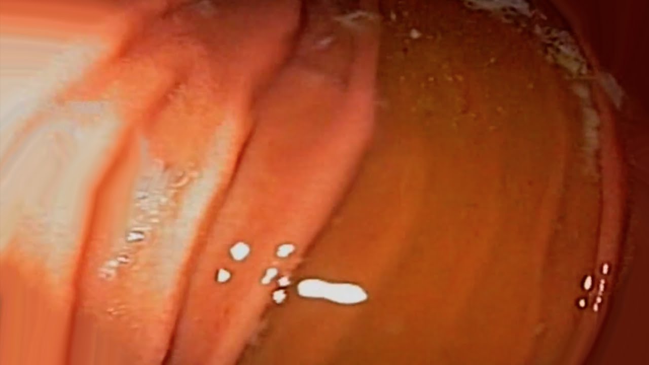 Gastroscopy