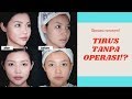MY LIP FILLER THREAD LIFT STORY LIDIA FANG