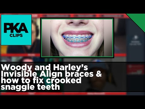 Woody and Harley’s Invisible Align braces & how to fix crooked snaggle teeth - PKA Clip