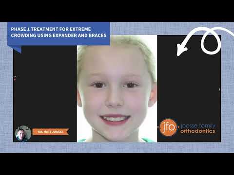 Phase 1 Treatment for Extreme Crowding Using an Expander and Braces | Joosse Family Orthodontics