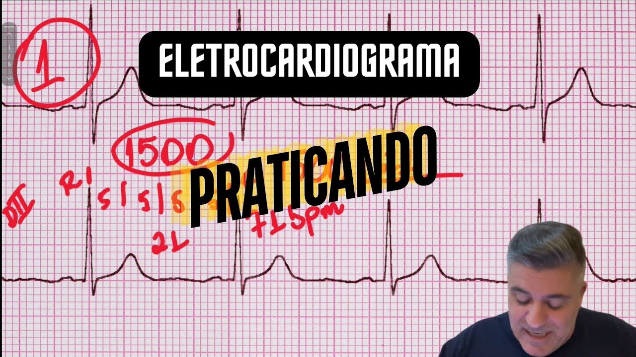 EXERCÍCIOS PARA CALCULAR FC NO ECG
