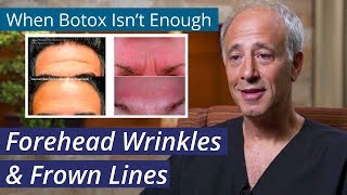 Treating Forehead Wrinkles [ How to get rid of #Stubborn #ForeheadLines when #Botox isn