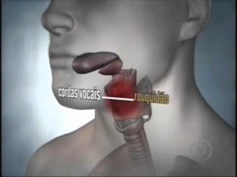 Papillary thyroid cancer diffuse sclerosing variant