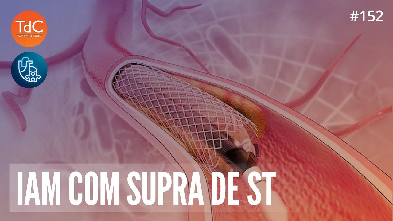 Infarto com Supra de ST feat. Doze por Oito: Episódio 152