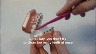 preview picture of video 'Swords Orthodontics brushing and cleaning with braces'