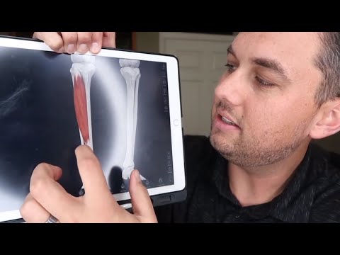 Shin Splints (Tibialis Anterior Pain) - How to Fix with Stretches and Exercises