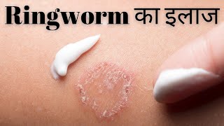 Ringworm infection | Ringworm home treatment | daad ka ilaj | daad treatment | दाद का इलाज