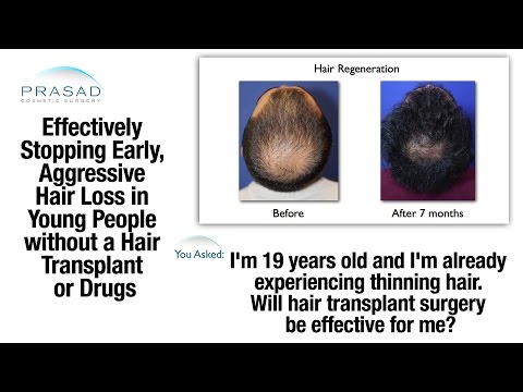 Why Hair Thinning at 19 Signals Rapid Hair Loss, and a Treatment to Manage Hair Loss Progression