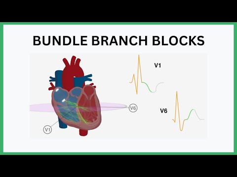 Bundle Branch Blocks Visualised