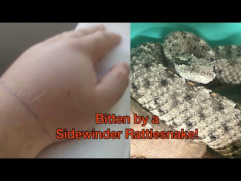 Sidewinder Rattlesnake Bite
